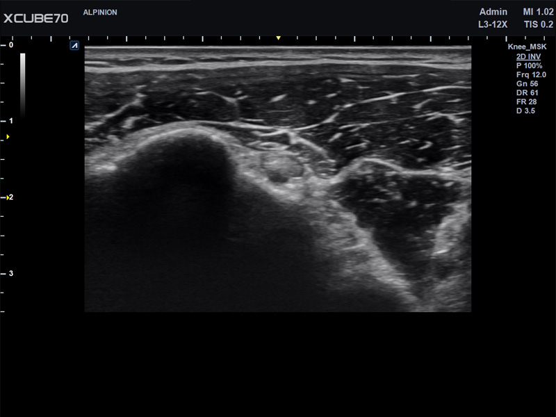 Liver in CF mode