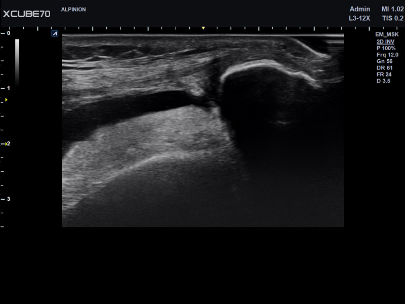 Liver in CF mode