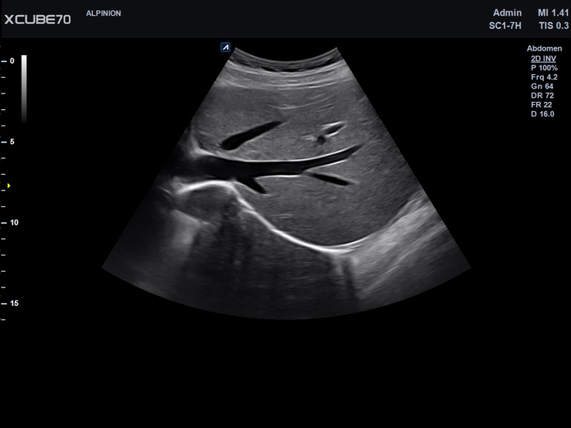 Liver in CF mode