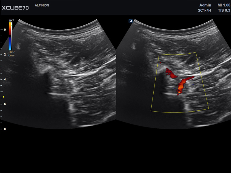 Liver in CF mode