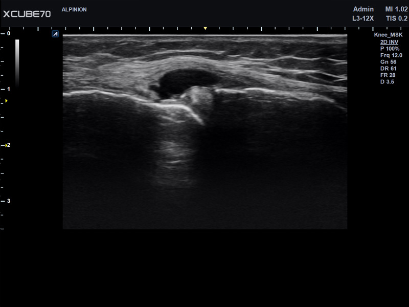 Liver in CF mode