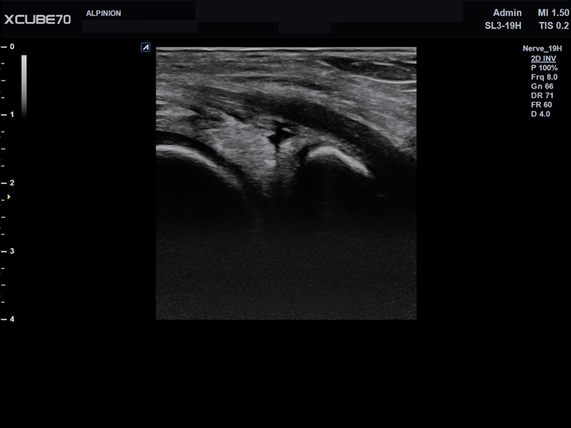 Liver in CF mode