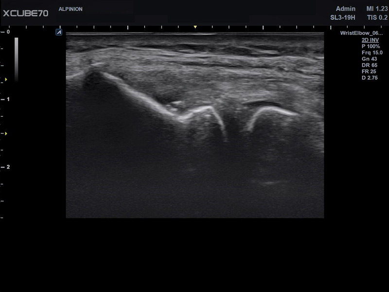 Liver in CF mode