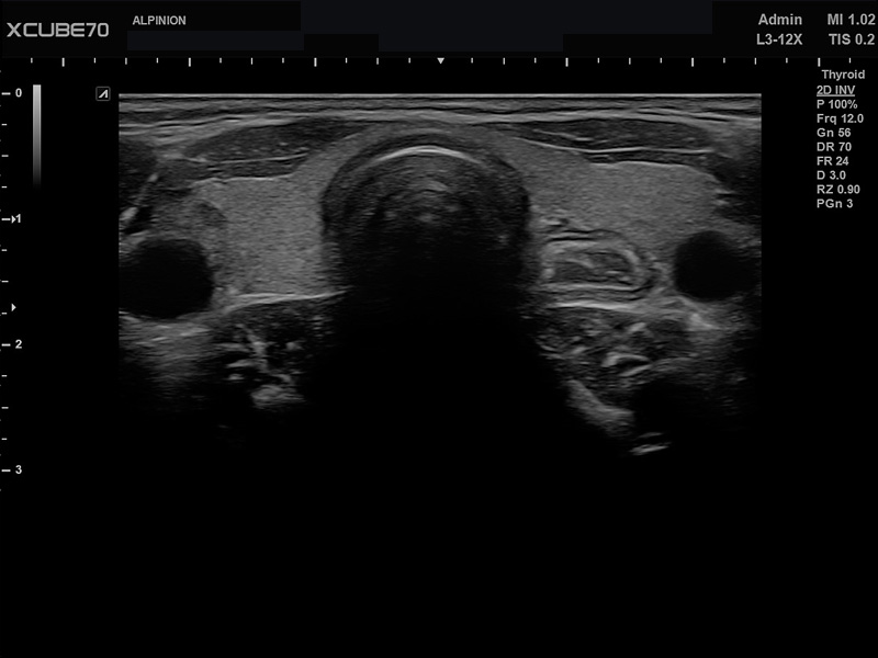 Liver in CF mode