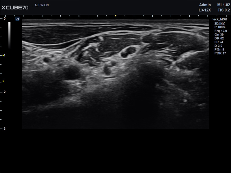 Liver in CF mode