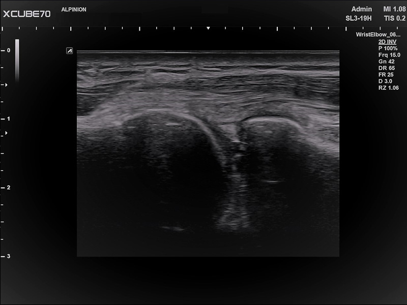 Liver in CF mode