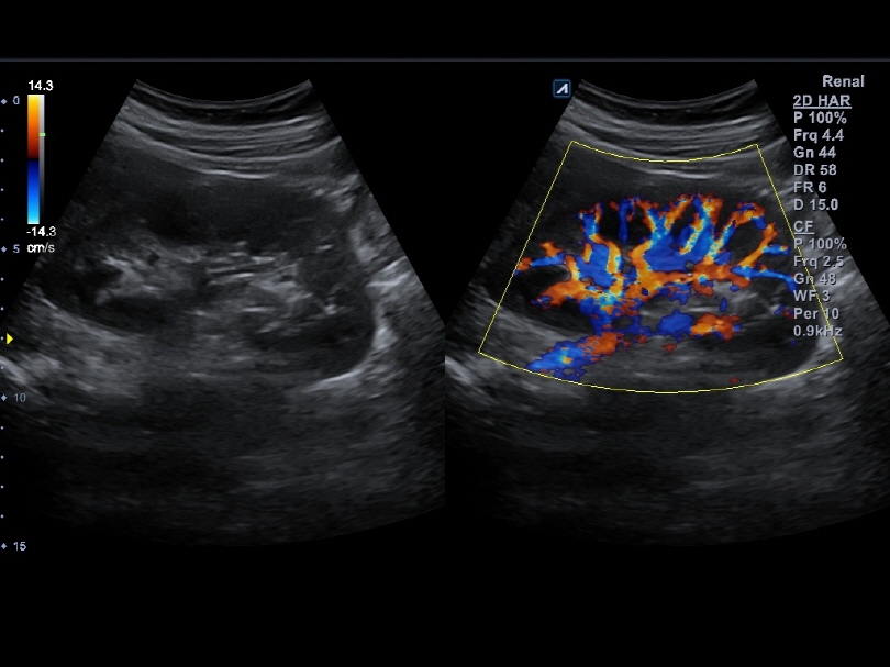 Liver in CF mode