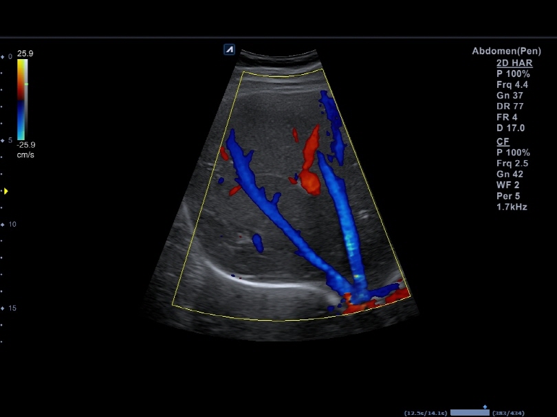 Liver in CF mode