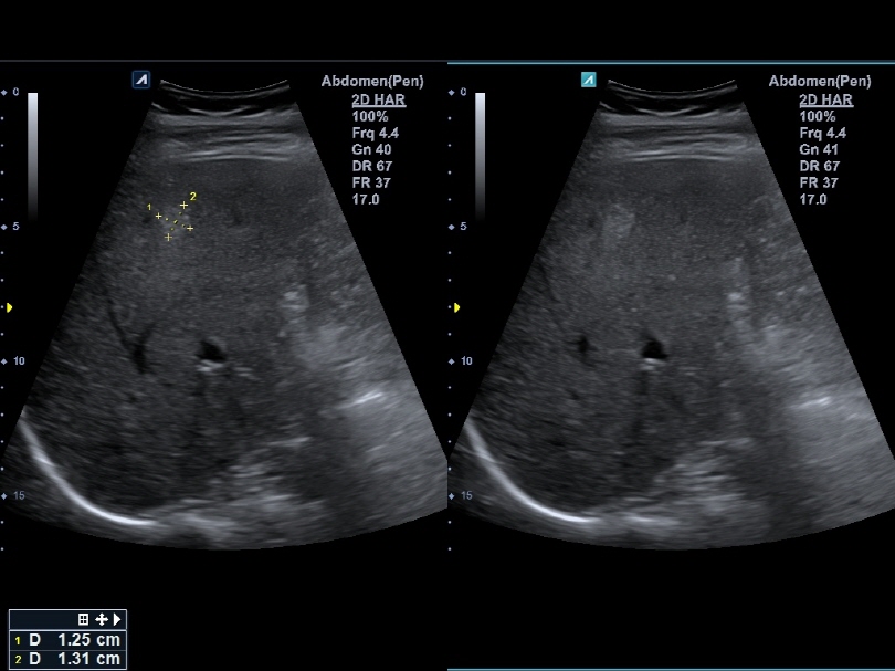 Liver in CF mode