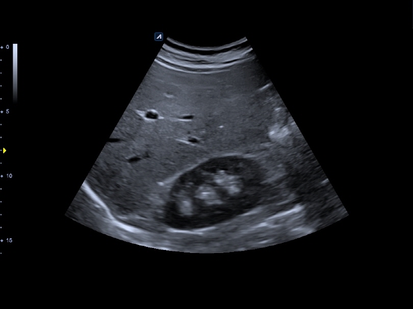 Liver in CF mode
