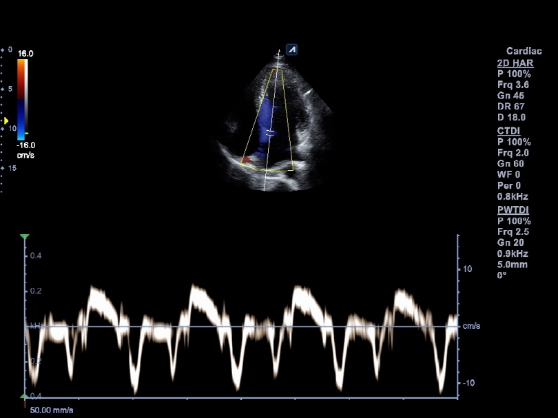 Liver in CF mode