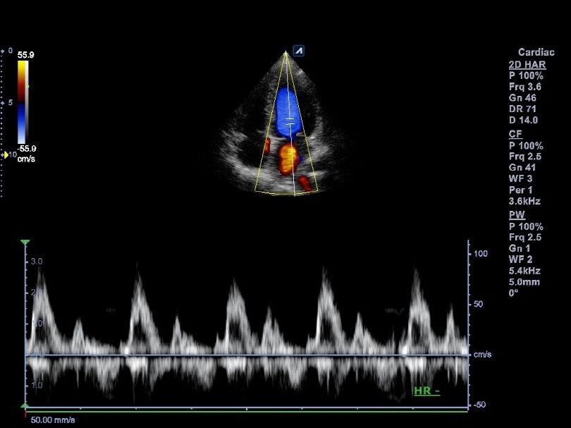 Liver in CF mode