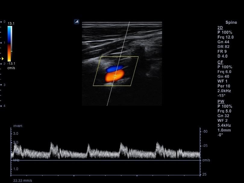 Liver in CF mode
