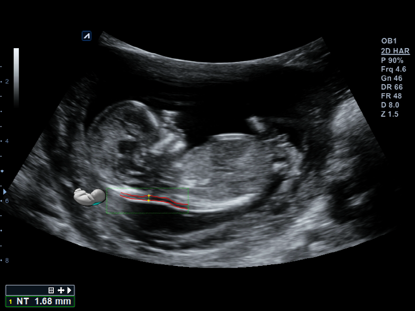Liver in CF mode