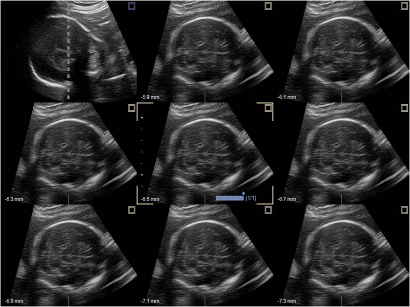 Liver in CF mode