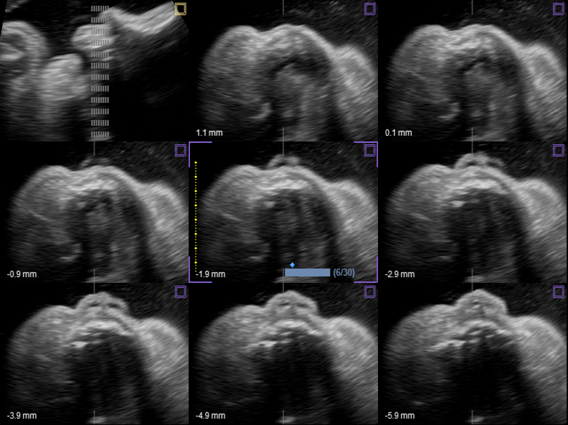 Liver in CF mode