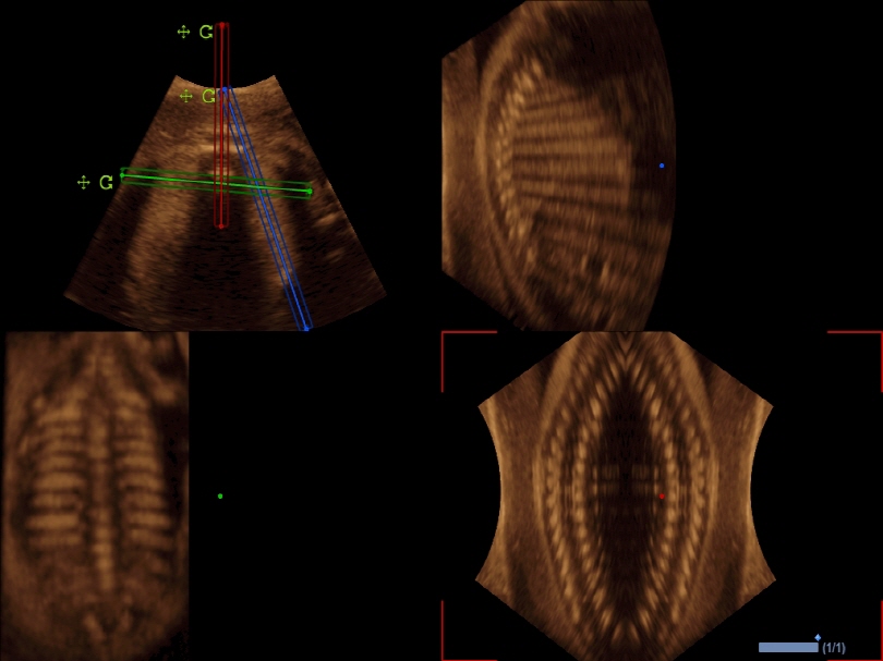 Liver in CF mode