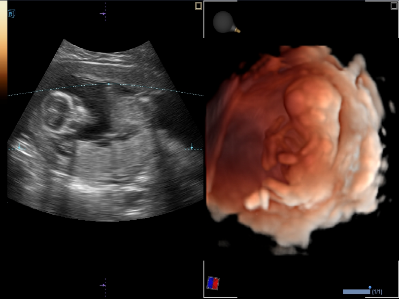 Liver in CF mode