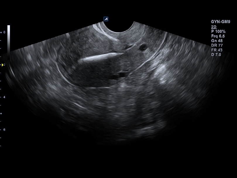 Liver in CF mode
