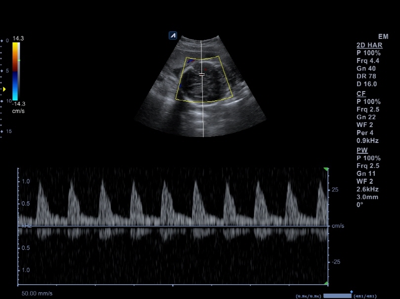 Liver in CF mode