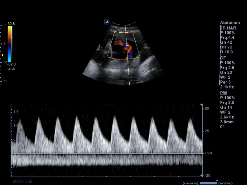 Liver in CF mode