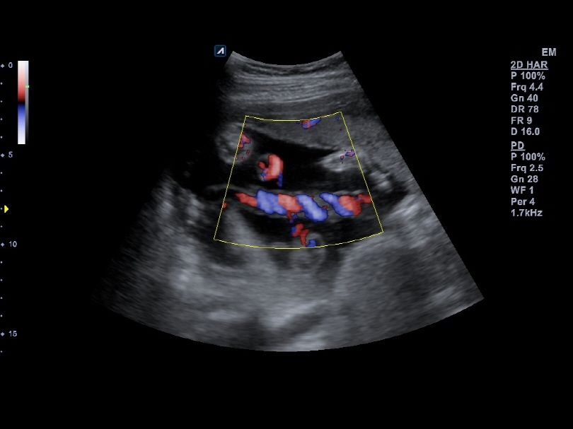 Liver in CF mode