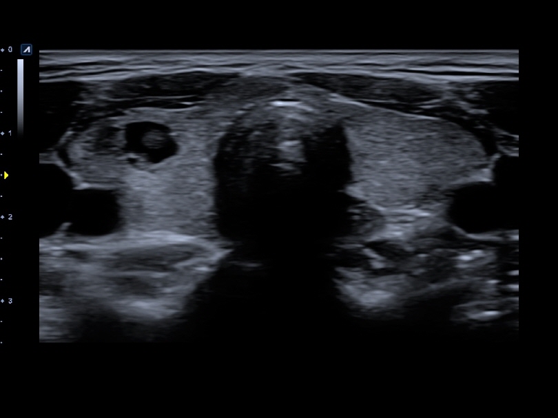 Liver in CF mode