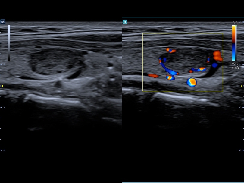 Liver in CF mode