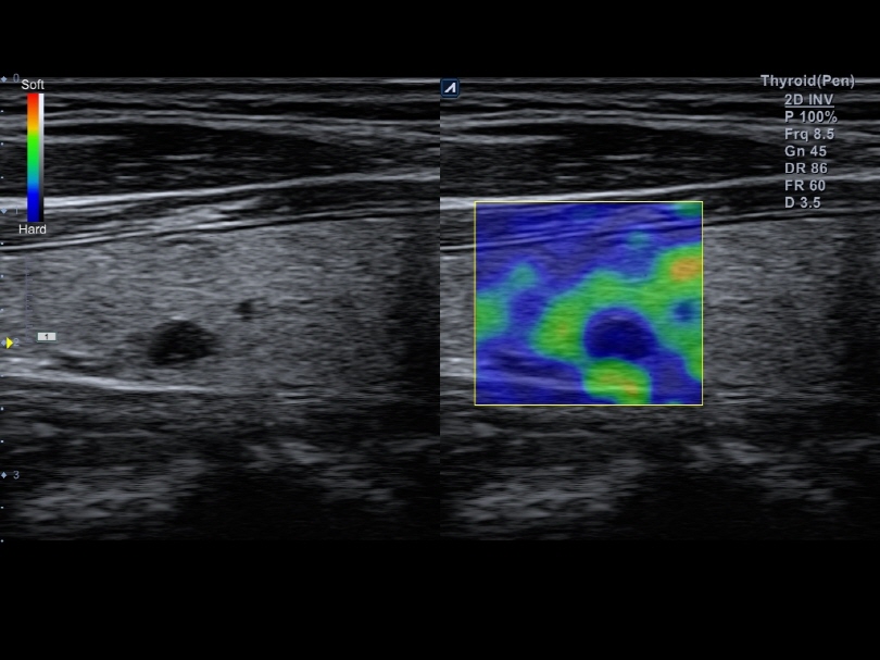 Liver in CF mode