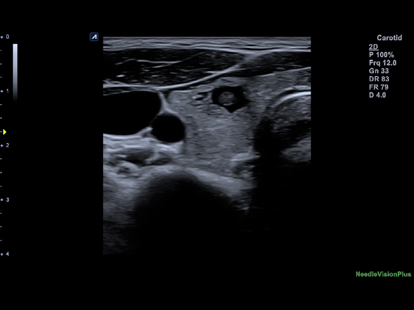 Liver in CF mode