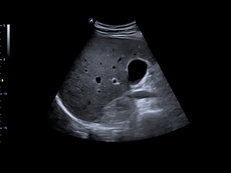 Liver in CF mode