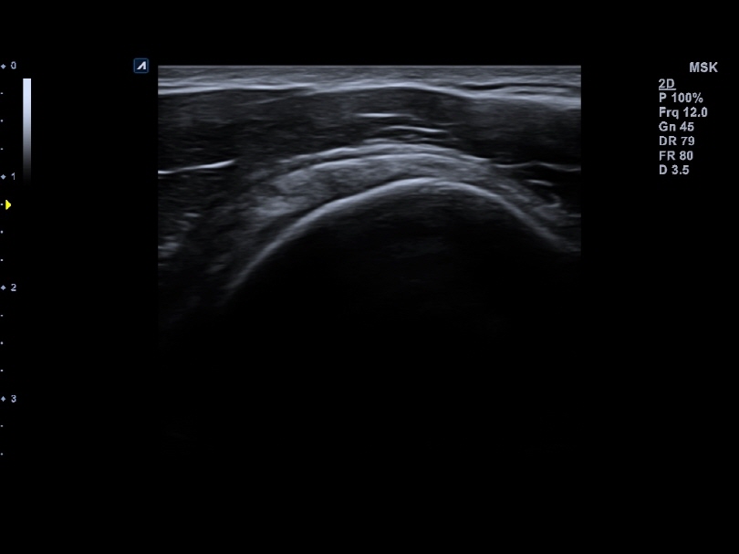 Liver in CF mode