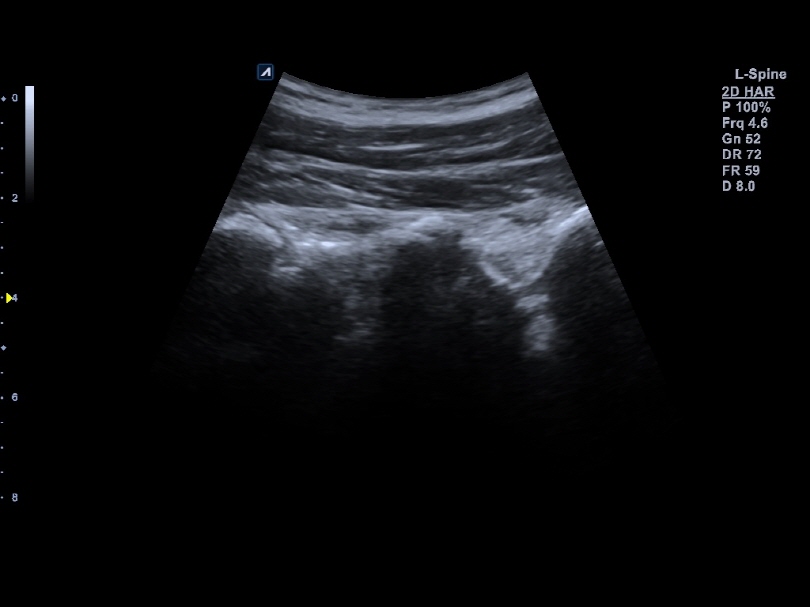 Liver in CF mode