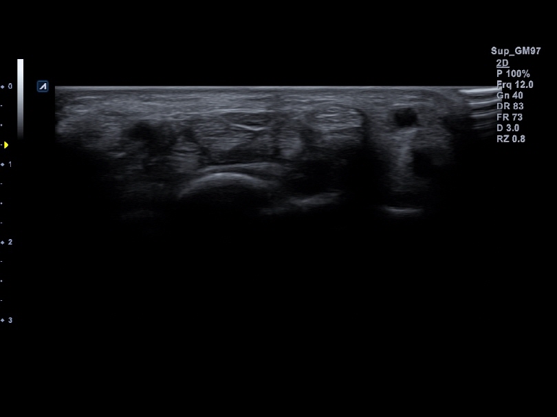 Liver in CF mode