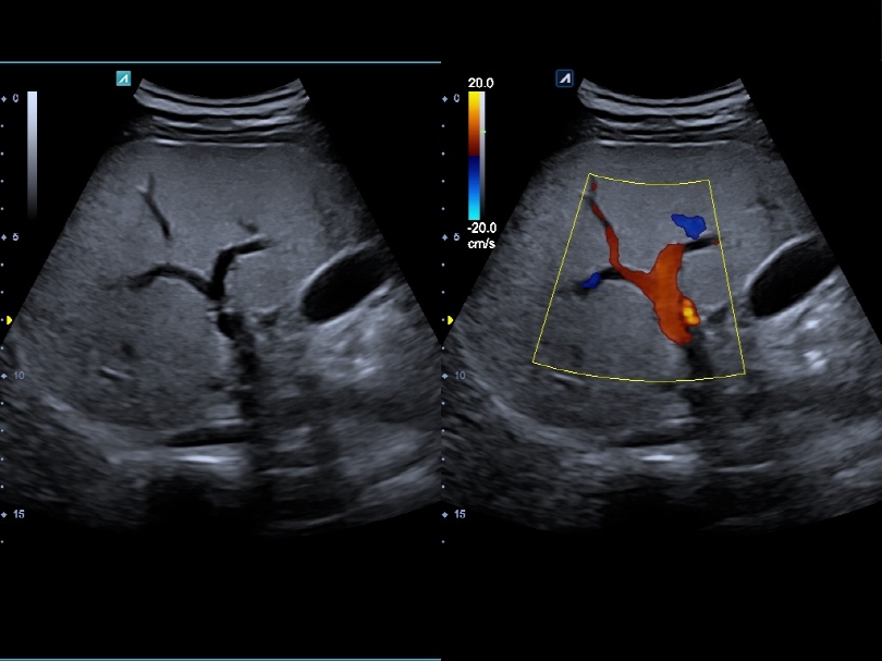 Liver in CF mode