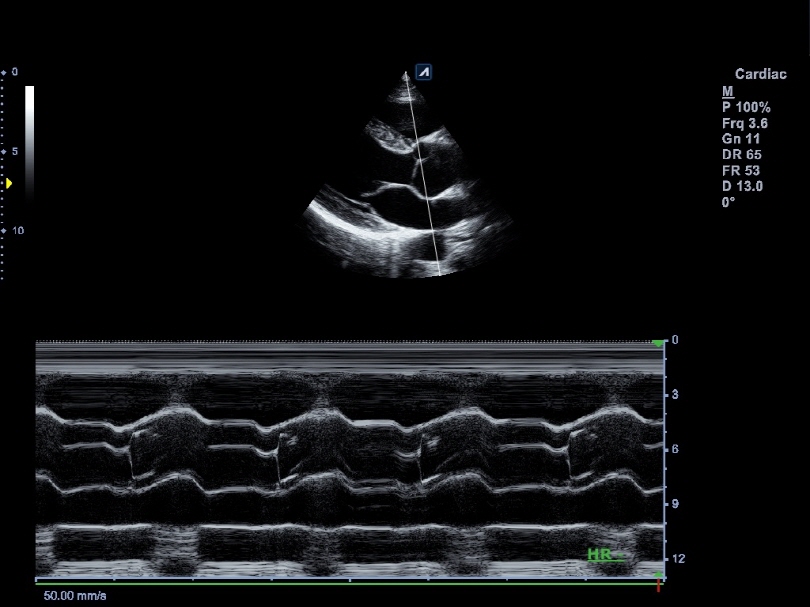 Liver in CF mode