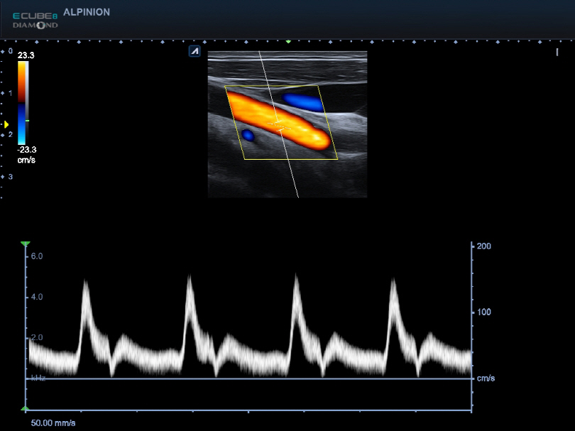 Liver in CF mode