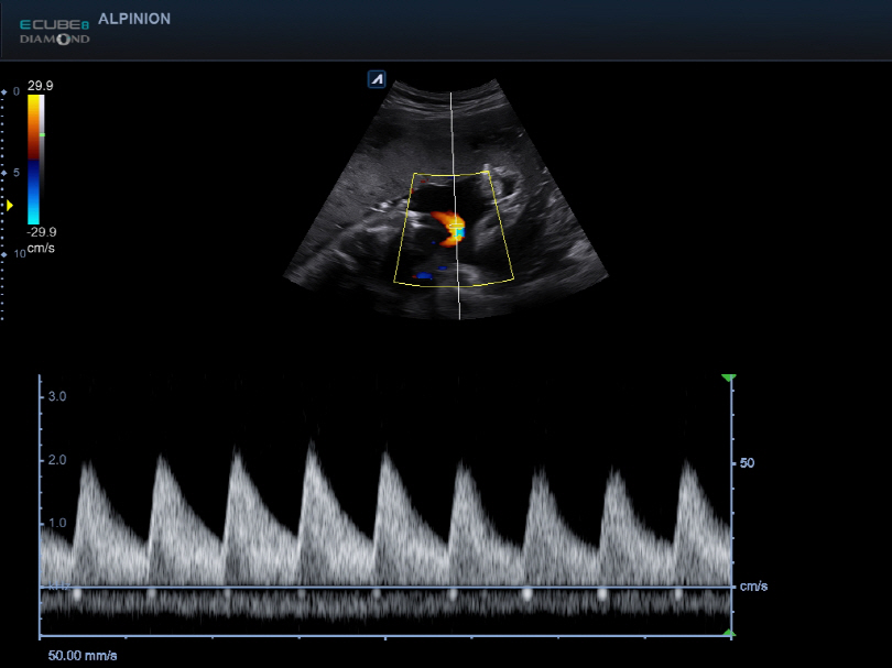 Liver in CF mode