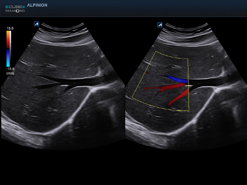 Liver in CF mode