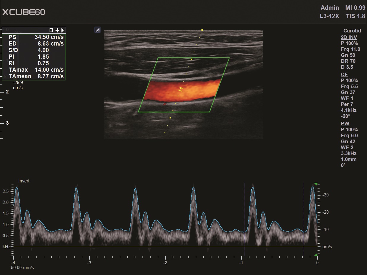 Liver in CF mode