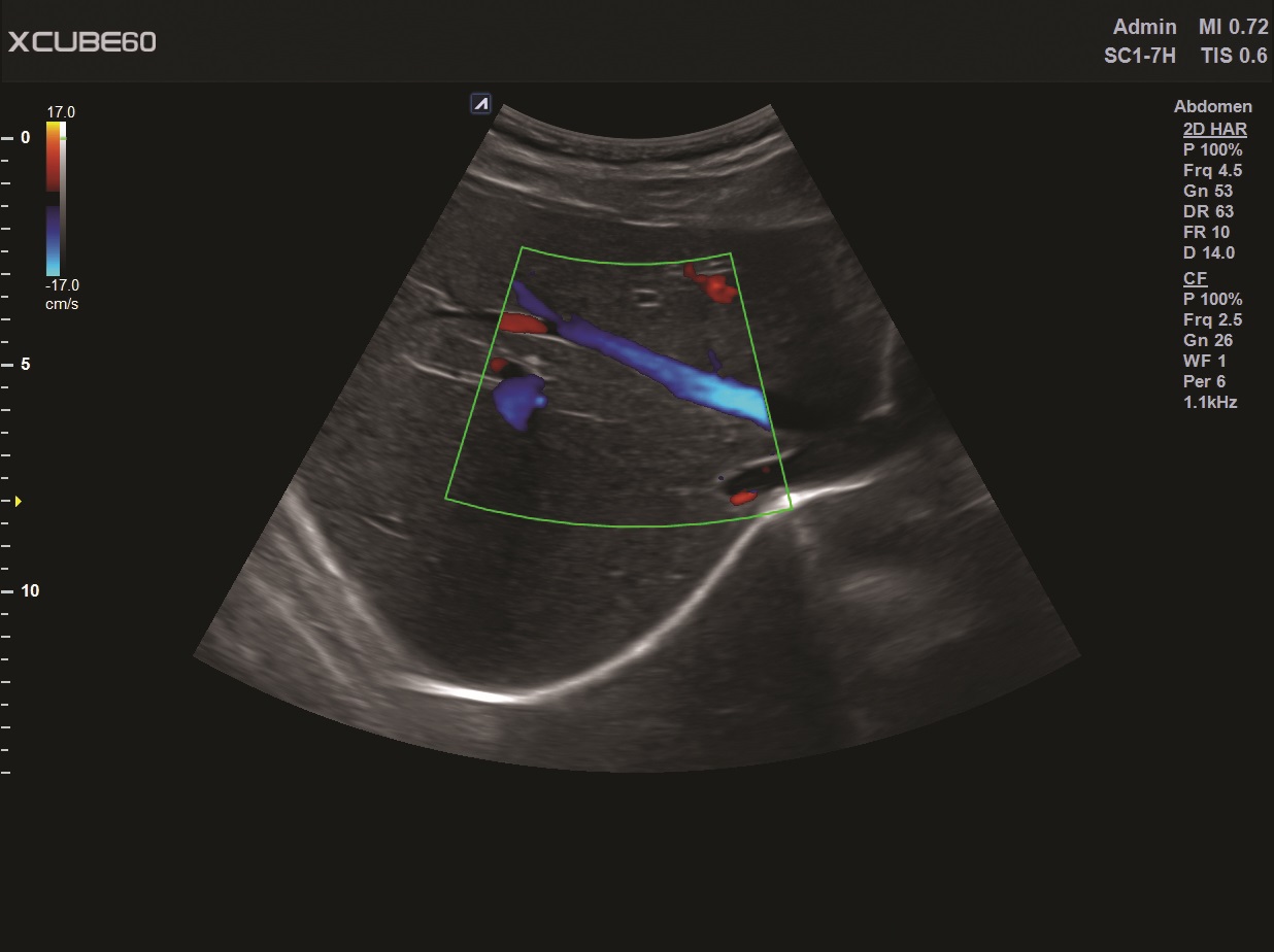 Liver in CF mode
