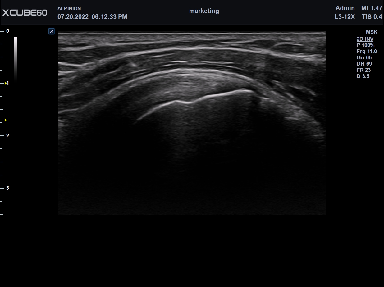 Liver in CF mode