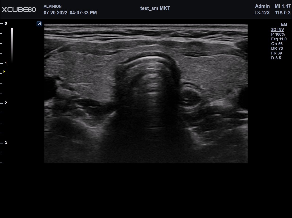 Liver in CF mode