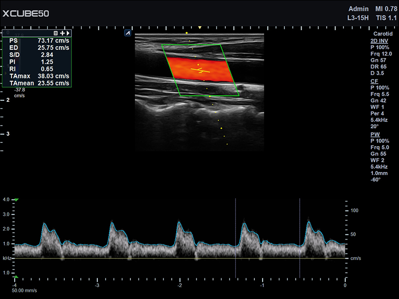 Liver in CF mode