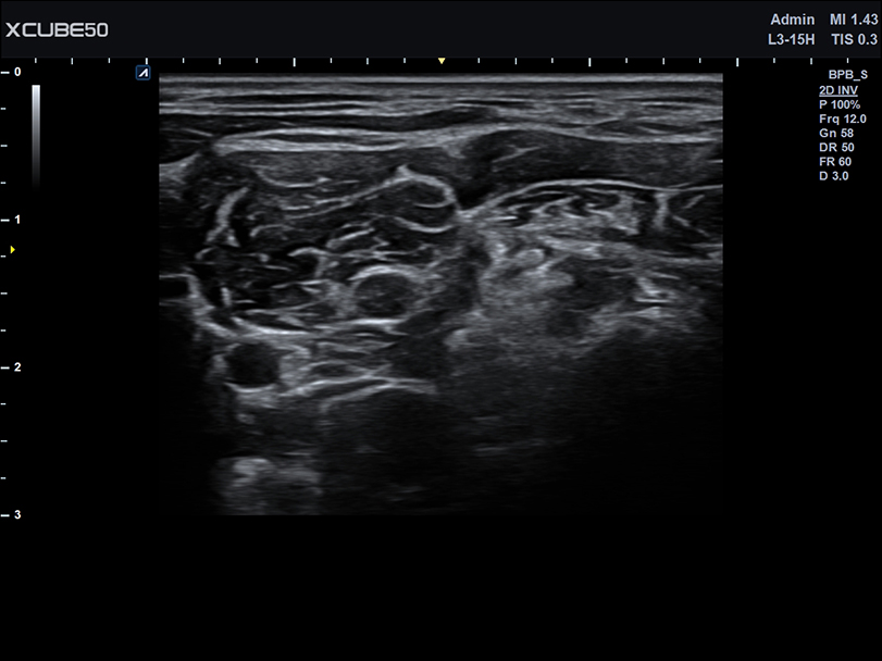 Liver in CF mode