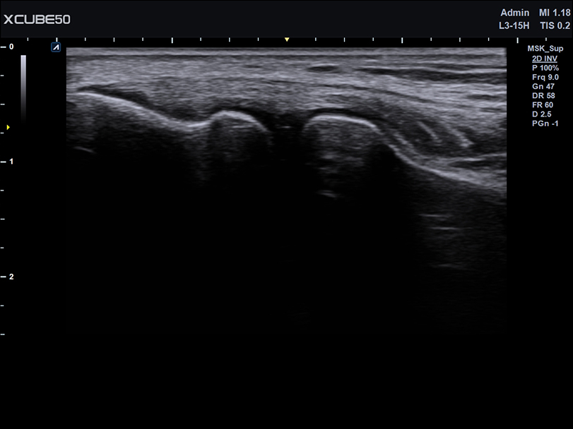 Liver in CF mode