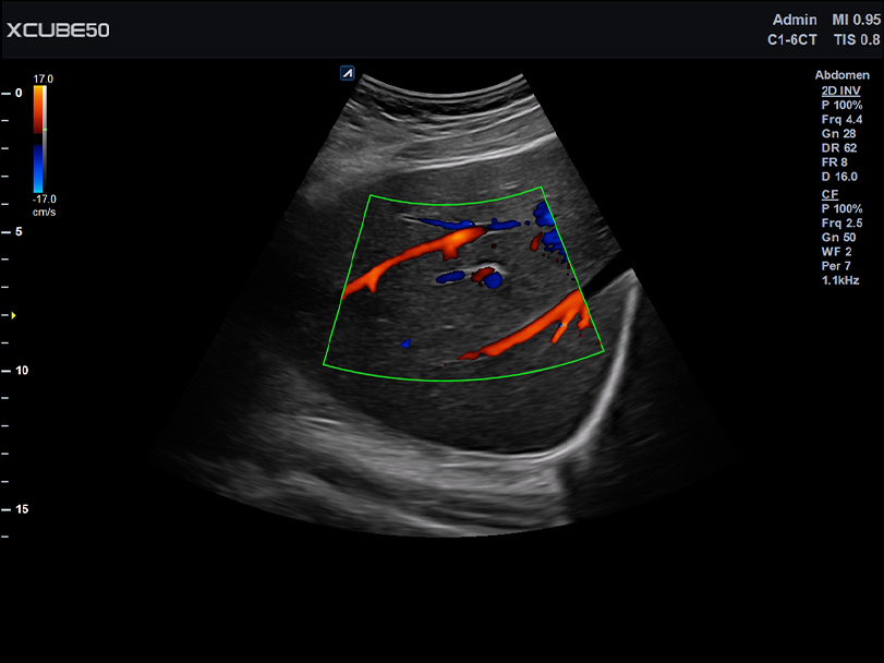 Liver in CF mode