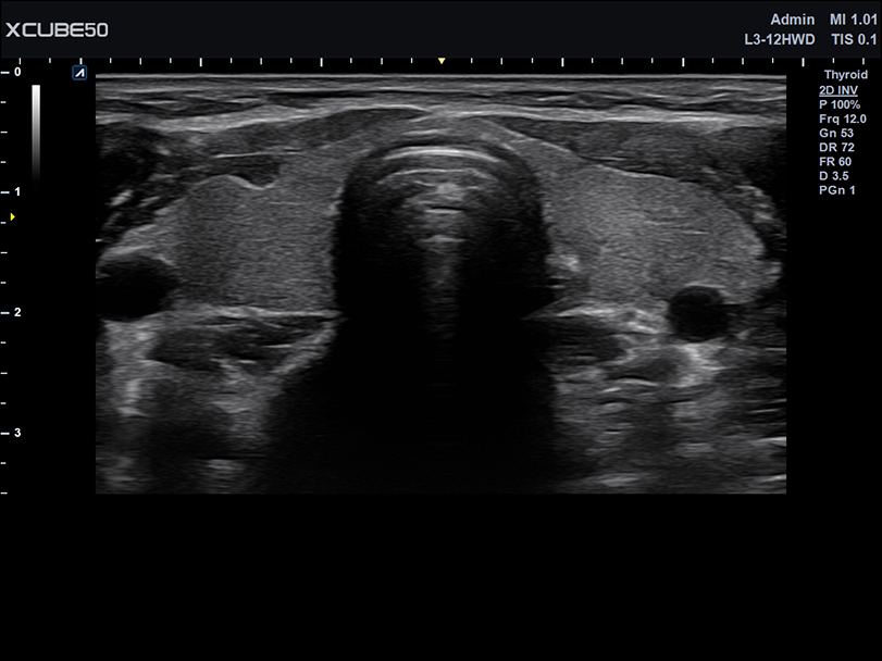 Liver in CF mode