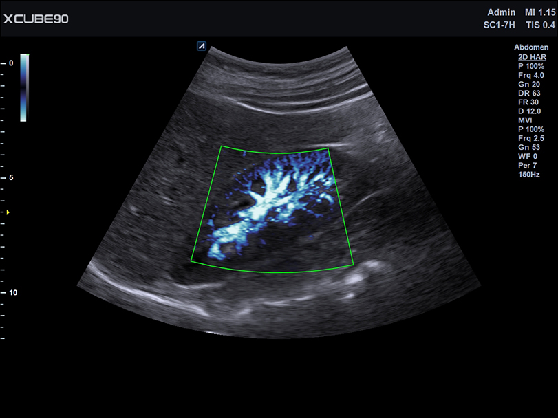 Kidney X+Microview