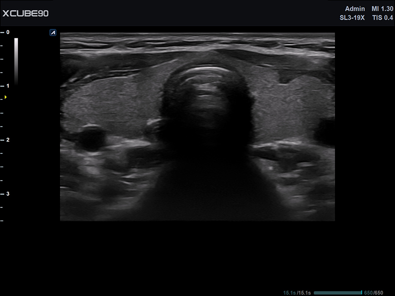Thyroid